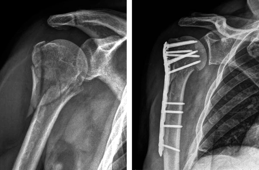 Fractura de hombro antes y después de cirugía