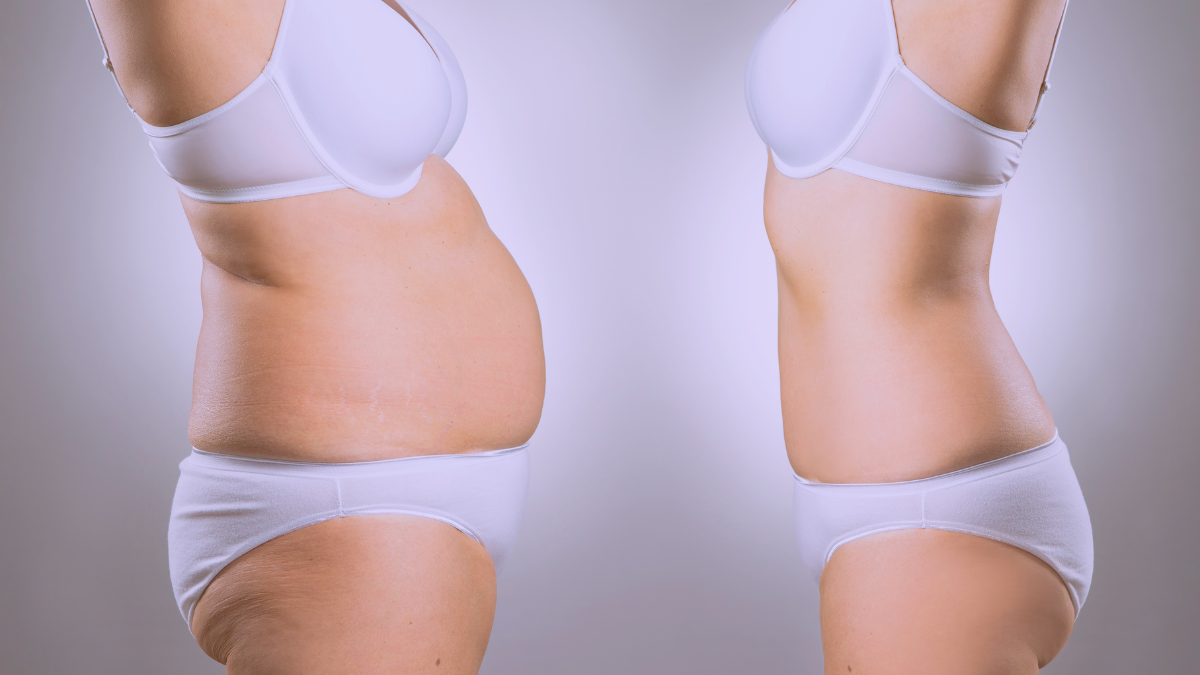 Liposucción: Remodelá tu silueta con precisión y seguridad