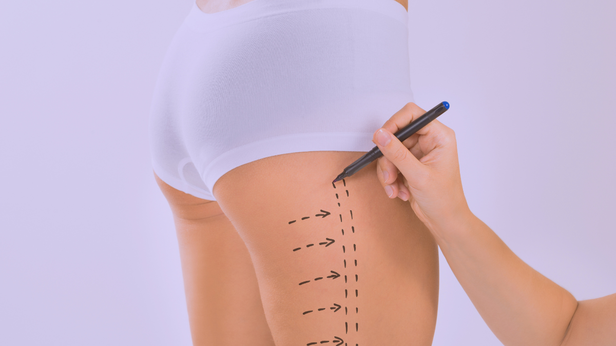 ¿Qué es la Dermolipectomía Crural o Lifting de Muslos?