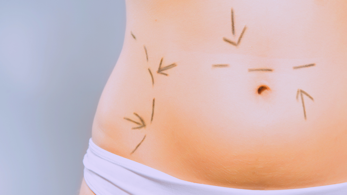 Abdominoplastía