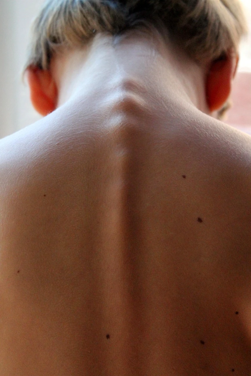 Dolor cervical - Desequilibrios de la columna vertebral
