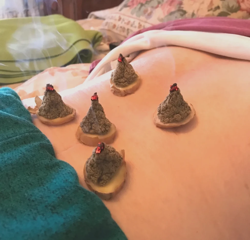 Moxibustión y Jengibre